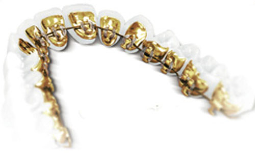 Lingual Braces